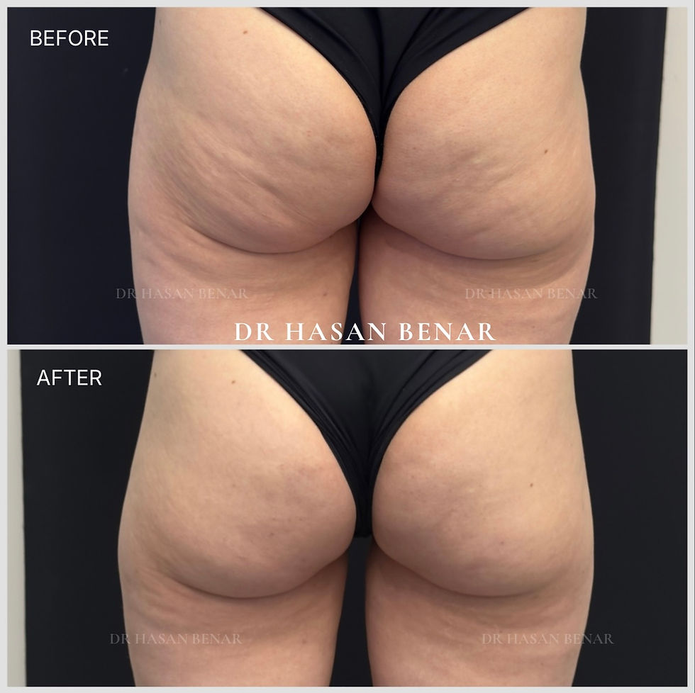 Cellulite subcision before and after — CelluSmooth treatment by Dr Hasan Benar, London