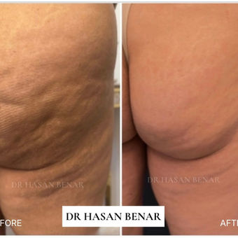 Before and after image showing improvement in cellulite dimpling following medical subcision treatment performed by a doctor in a UK clinic.
