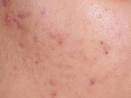Essential Dos and Don'ts for Managing Acne Effectively