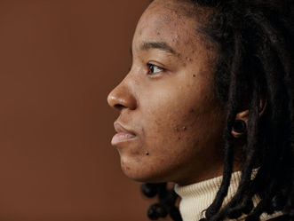 Acne: Cause & Treatment Protocol