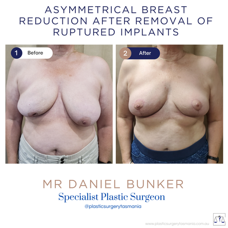 Staged Removal of Ruptured Implants, Capsulectomy, Breast Reduction