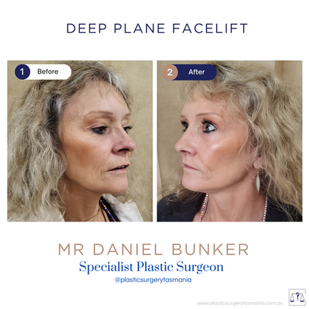 Deep plane facelift and neck lift by Dr. Daniel Bunker Tasmania