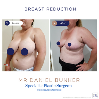 2 months post breast reduction by dan bunker