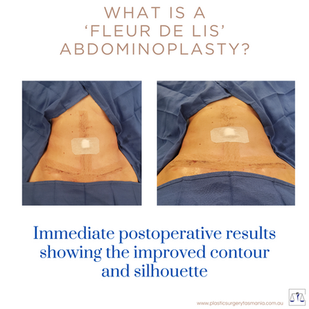 FDL Abdominoplasty