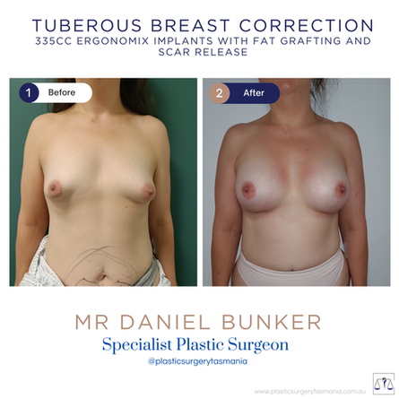 breast augmentation 335cc tuberous breast correction mr dan bunker
