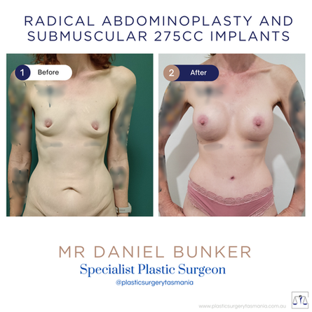 Breast augmentation 275 cc submuscular mr dan bunker