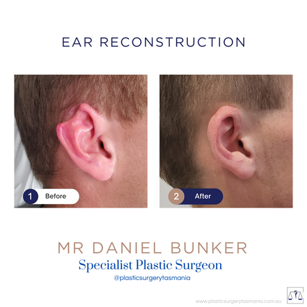 Ear Surgery Dr. Daniel Bunker