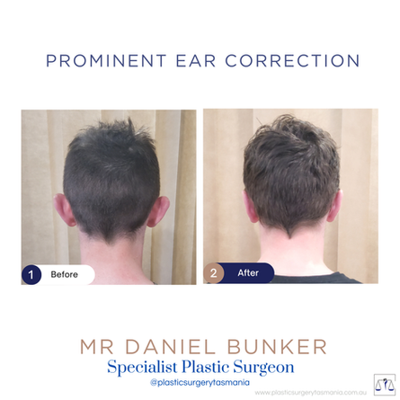 Prominent Ear Surgery by Dan Bunker