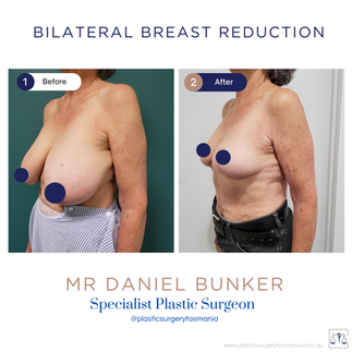 3 months post breast reduction by dan bunker