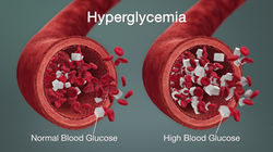 Hyperglycemia