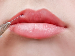 Does Russian Lip Filler Alter Lip Projection?
