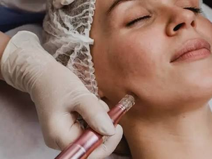 Can Acne Scar Treatment Improve Skin Texture?
