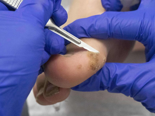 How To Speed Up Healing After Wart Removal