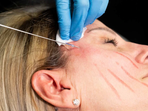 How Is Thread Lift Price Evaluated?