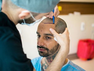 How To Prepare for Hair Transplant Cost Discussions?