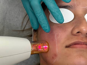 How Effective Is Laser Skin Resurfacing for Deep Scarring?
