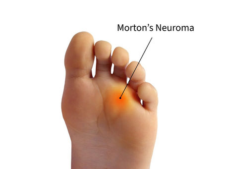 Image shows how Morton's Neuroma look like.