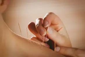 Acupuncture treatment illustrating connective tissue pathways and neuroscience-supported pain relief at Zen Attitude Wellness.