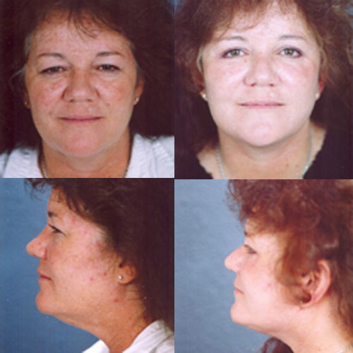 facelift5Large