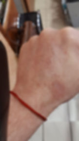 Eczéma - 1j après le soin énergétique