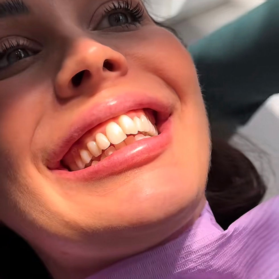 My orthodontic journey as Finnish person in Estonia: from aligners to MARPE and corticotomies. THE BEFORE 🌒