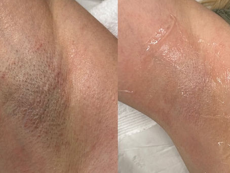 Why Is My Left Armpit Smoother Than My Right After Laser Hair Removal?