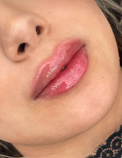 "Lip fillers voor en na 0.5ml subtiel volume Amsterdam Lana Skyn"