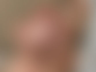 What Is Microneedling? Benefits, Results, Cost & Recovery Explained