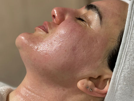 What Is Microneedling? Benefits, Results, Cost & Recovery Explained