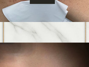 Is Laser Hair Removal Safe?