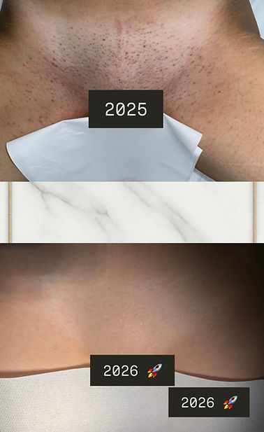 Before and after bikini lightsheer laser hair removal.jpg
