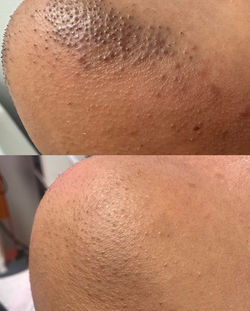 armpits-fine-hair-laser-lightsheer-before-after.jpg