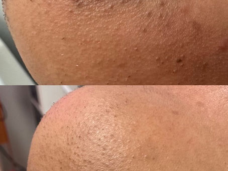 Why Do I Still Have Stubble After Multiple Laser Hair Removal Sessions?