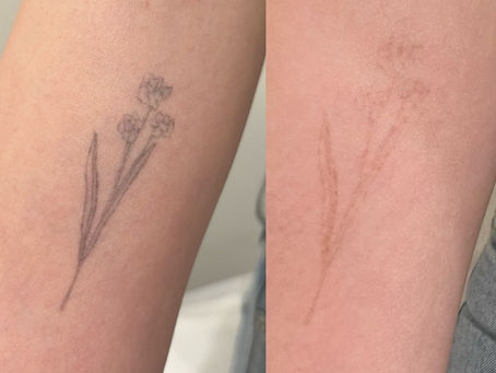 Is Tattoo Removal Painful? What It Really Feels Like (Honest Answer)