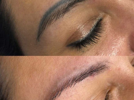 Can One Sunny Day Ruin Tattoo Removal Results? Expert Advice After Sun Exposure