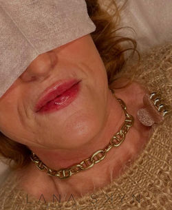 "Lip fillers Cupido's boog definitie voor en na Revolax