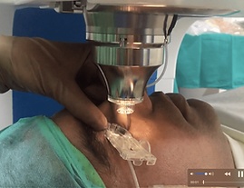 Docking on Femto LASIK Machine for bladeless cornea flap