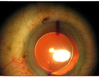 Toric-Intraocular-Lens-to-correct-astigmatism