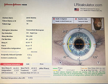 LRI-Planning-for-astigmatic-correction