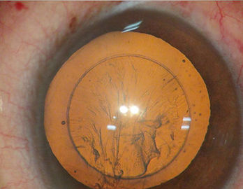 Perfect-Capsuolrhexis-and-clean-capsular-bag-in-which-the-IOL-will-be-implanted
