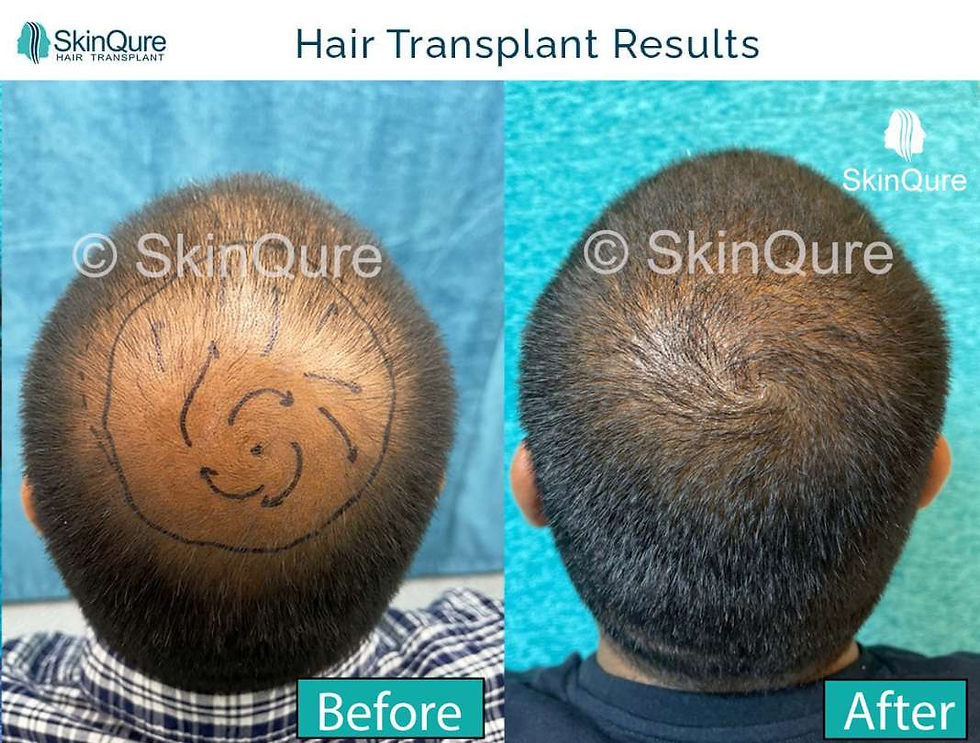 crown hair transplant in delhi