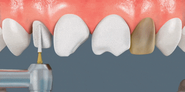 Veneers_GIF.gif