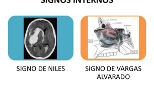 Importancia de la hemorragia en la porción petrosa del hueso temporal y hemorragia etmoidal