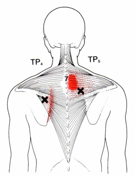 Thumbnail: Phase 1(Week 1-8) Rotator Cuff Workout Shoulder pain