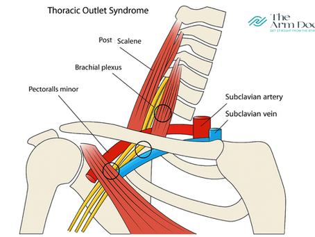 Why Do My Hands Go Numb While Sitting at the Computer? Thoracic Outlet and How to fix it.