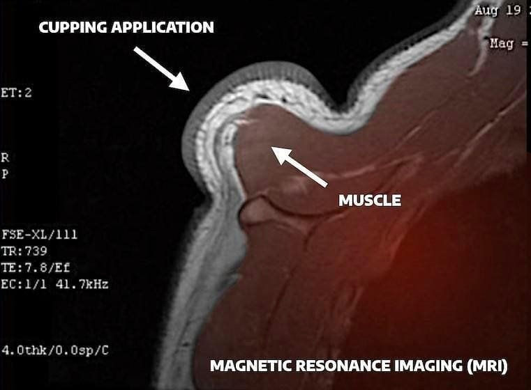Why cupping helps with a massage?