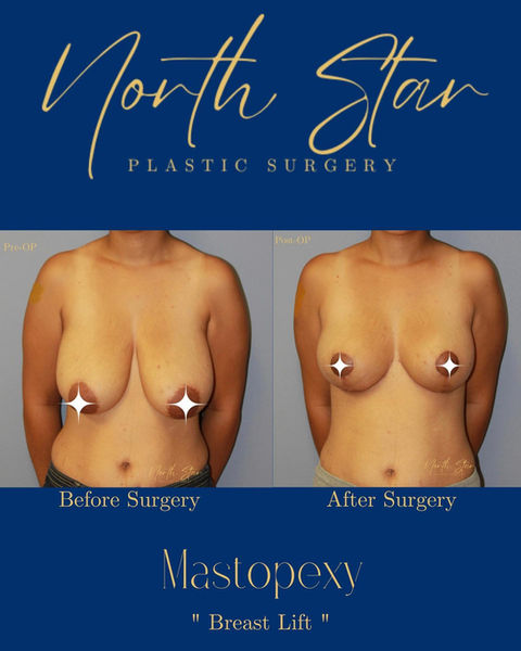 Breast lift, boob job Fairbanks, North Star Plastic Surgery Fairbanks, Martell, Cosmetic Surgeon, breast plastic surgery, saggy breast surgery, Fairbanks breast surgery