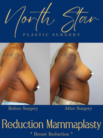 Breast reduction surgery, boob job Fairbanks, North Star Plastic Surgery Fairbanks, Martell, Cosmetic Surgeon, breast plastic surgery, back pain breast surgery, Fairbanks breast surgery