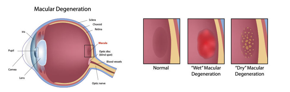 macular, degeneration, eye, fairbanks, wet macular degeneration, dry macular degeneration, treatment, surgery