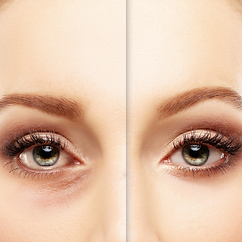BLEFAROPLASTIA (1).png